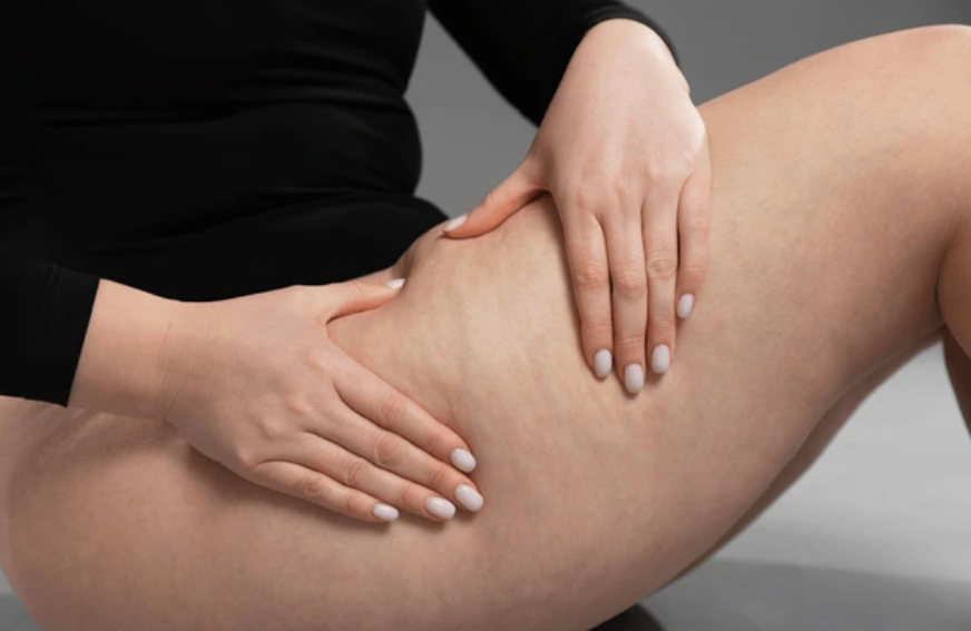 cellulite traitement