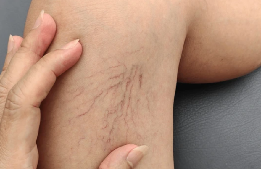 varices traitement