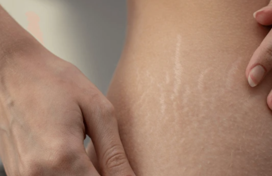 traitement des vergetures